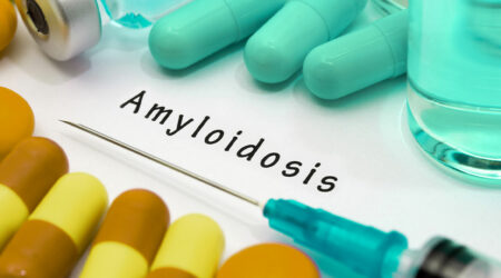 Amyloidosis &#8211; types, symptoms, diagnosis, and treatment