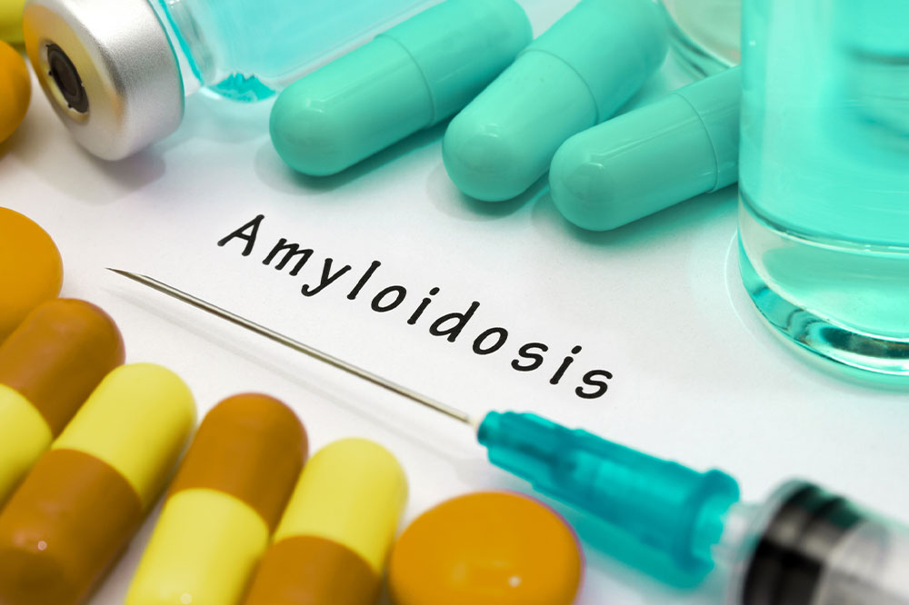 Amyloidosis &#8211; types, symptoms, diagnosis, and treatment