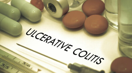 Ulcerative colitis &#8211; Causes, symptoms, and management