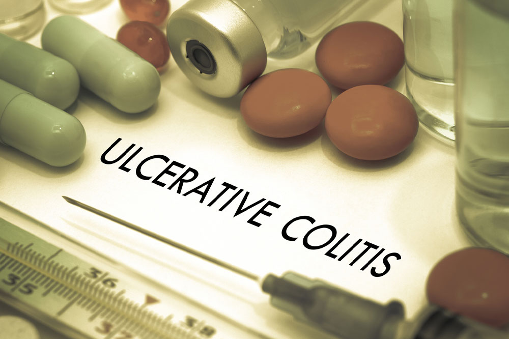 Ulcerative colitis &#8211; Causes, symptoms, and management