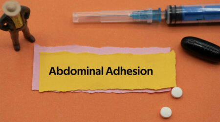 Abdominal adhesions &#8211; Causes, symptoms, and more