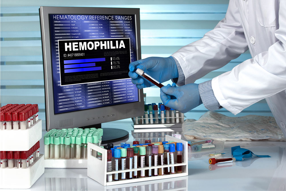 Hemophilia &#8211; Types, symptoms, and management