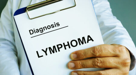 Lymphoma &#8211; Causes, risk factors, symptoms, and more