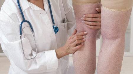 Varicose veins &#8211; Causes, symptoms, management, and prevention