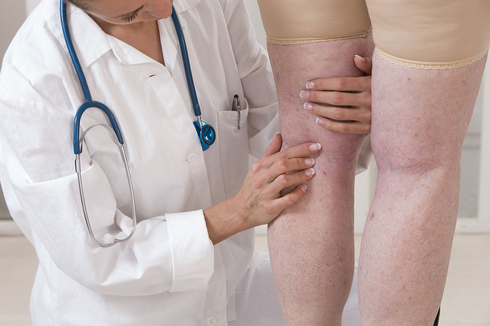 Varicose veins &#8211; Causes, symptoms, management, and prevention