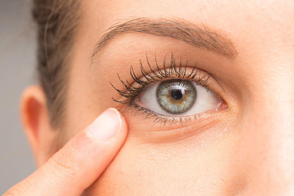 Eye bags &#8211; Causes, symptoms, and management remedies