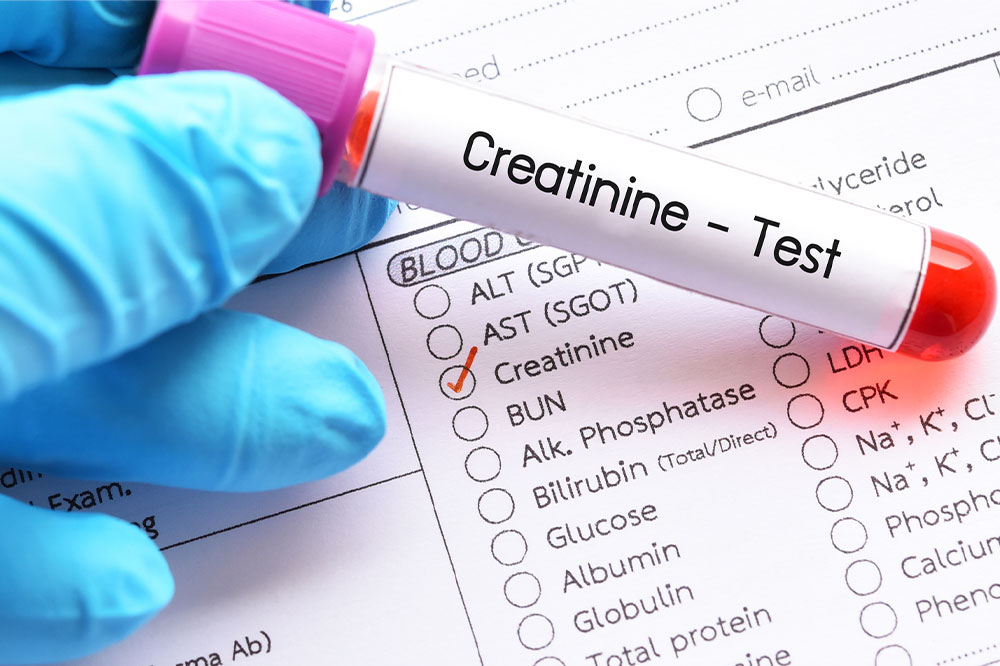 7 natural ways to lower creatinine levels